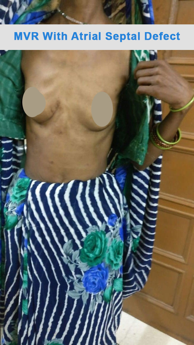 ASD - Atrial Septal Defect surgical photo