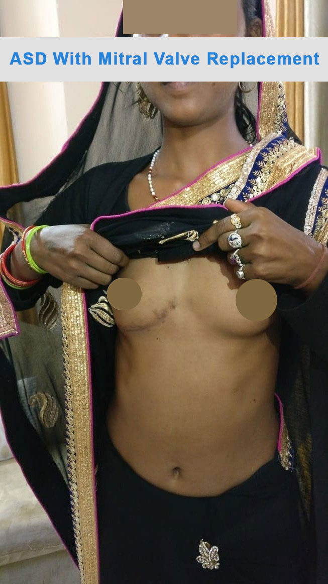 ASD - Atrial Septal Defect surgical photo