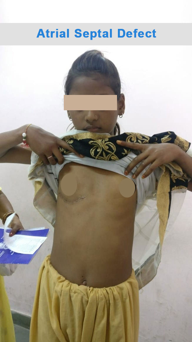 ASD - Atrial Septal Defect surgical photo