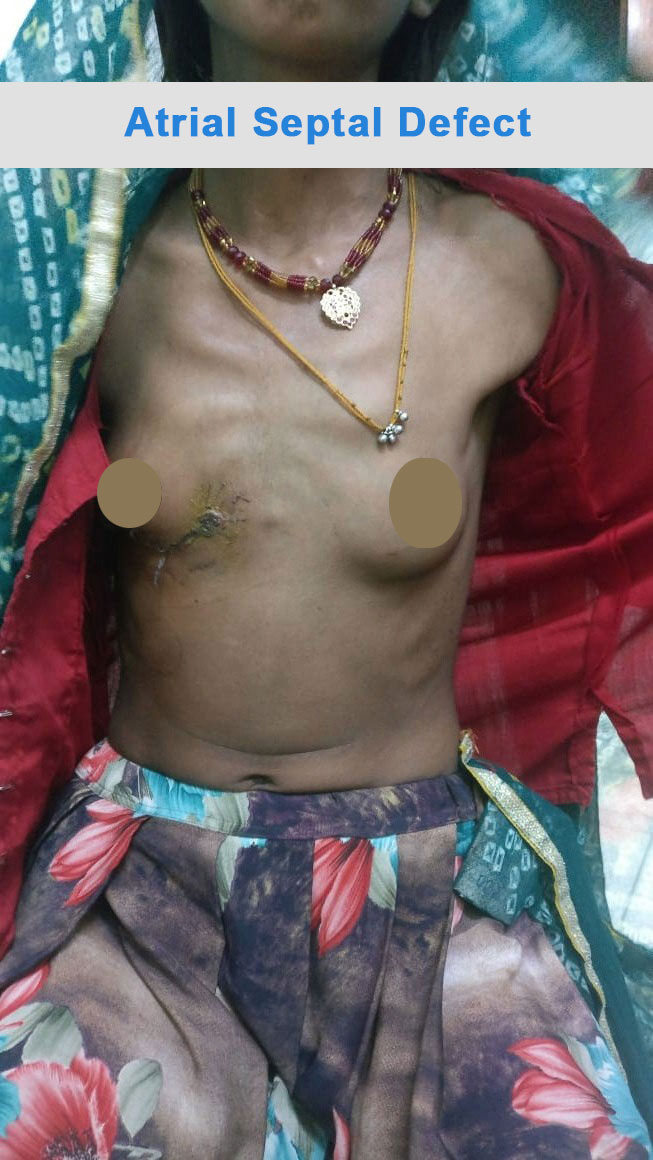 ASD - Atrial Septal Defect surgical photo