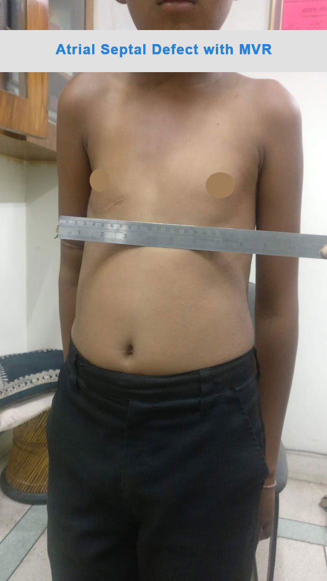 ASD - Atrial Septal Defect surgical photo