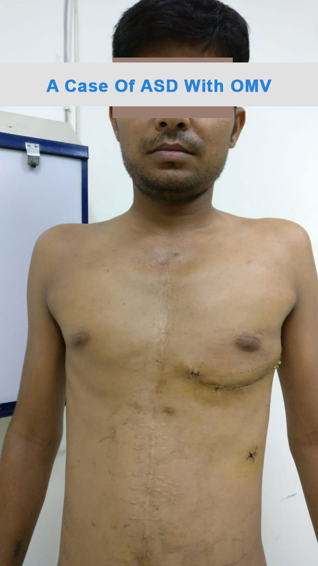 ASD - Atrial Septal Defect surgical photo