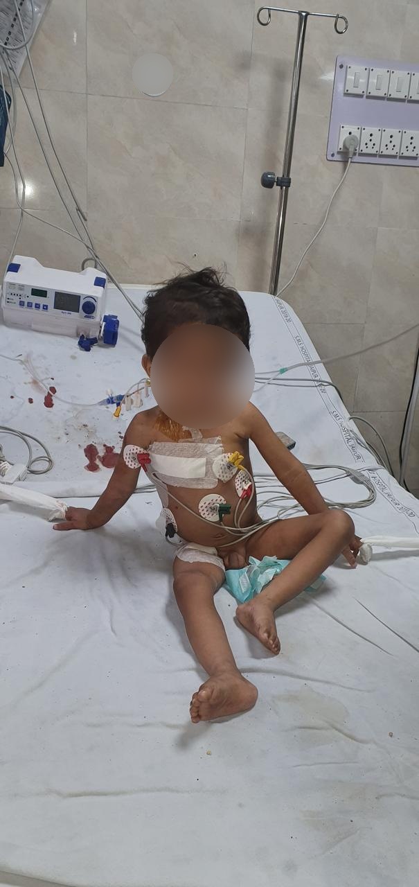 ASD - Atrial Septal Defect surgical photo