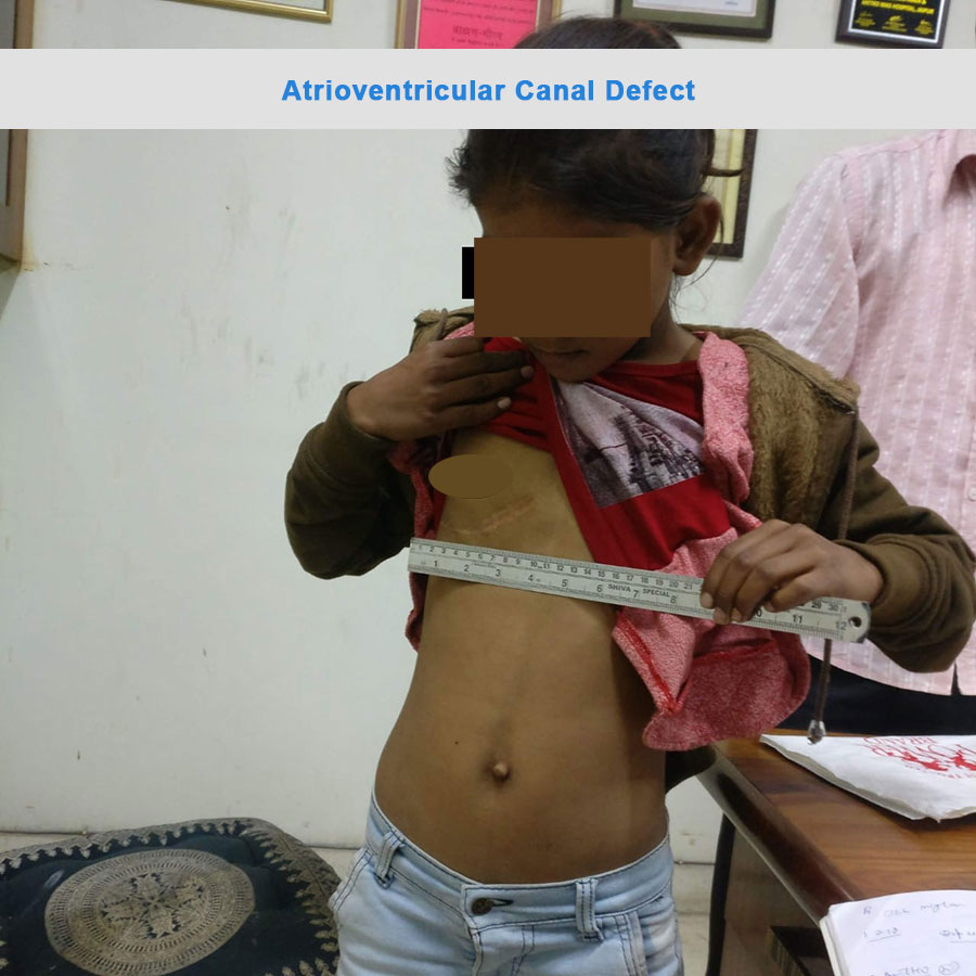 AV Canal Defect surgical photo