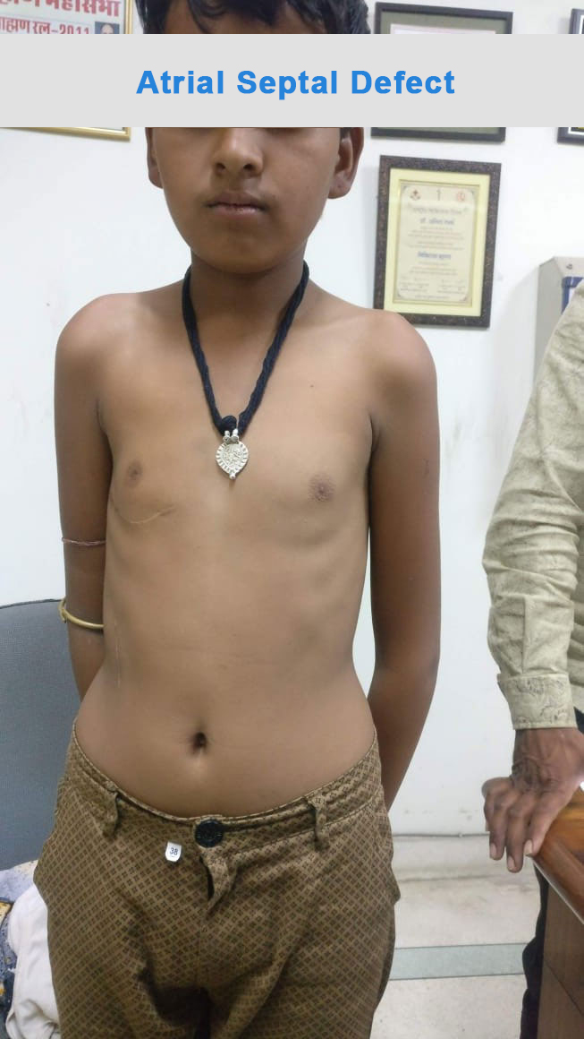 AV Canal Defect surgical photo