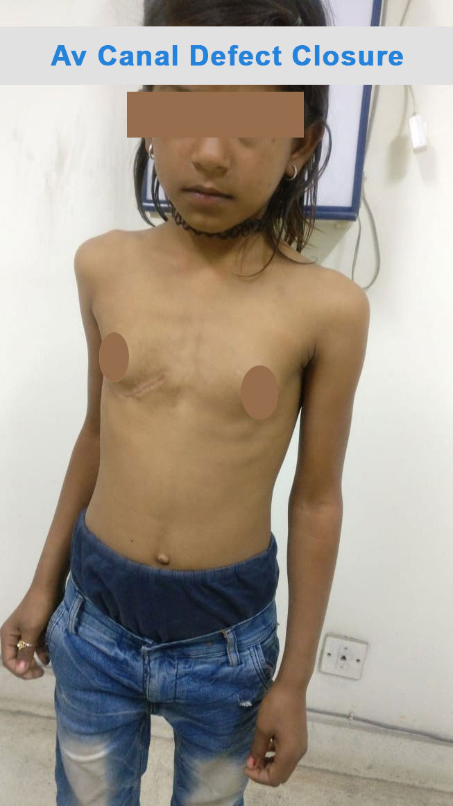 AV Canal Defect surgical photo