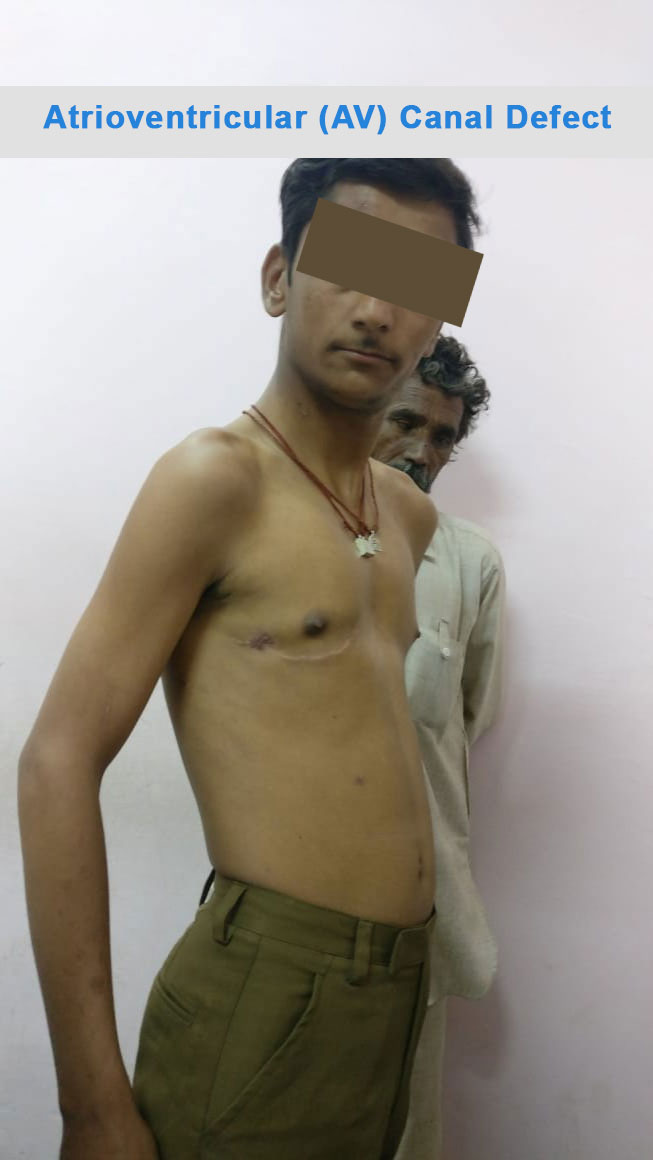 AV Canal Defect surgical photo