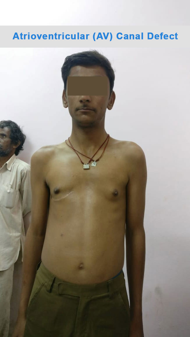 AV Canal Defect surgical photo