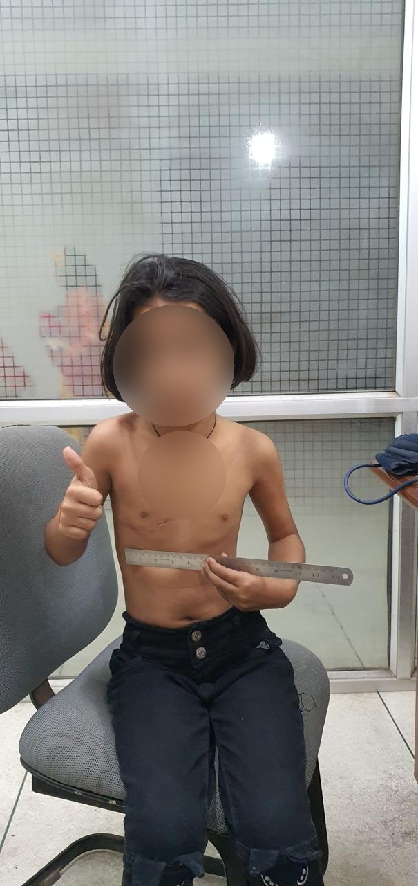 AV Canal Defect surgical photo