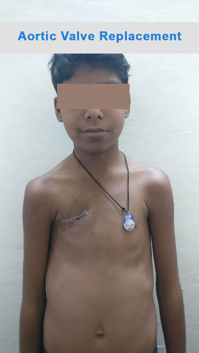 AVR - Aortic Valve Replacement surgical photo