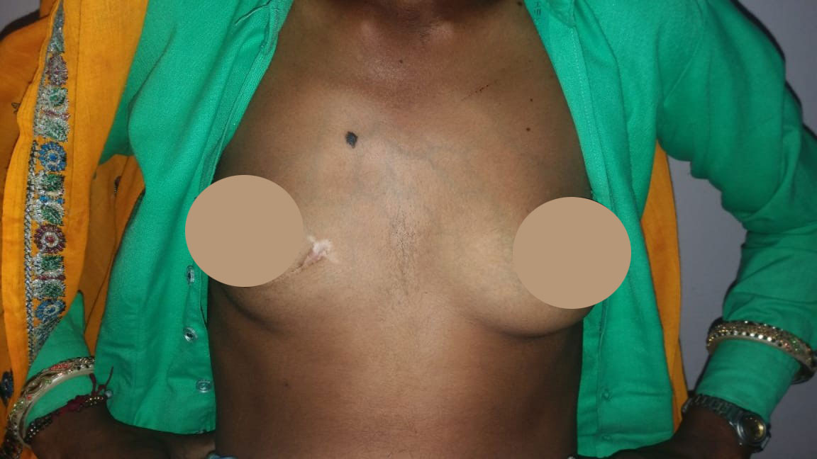 AVR - Aortic Valve Replacement surgical photo