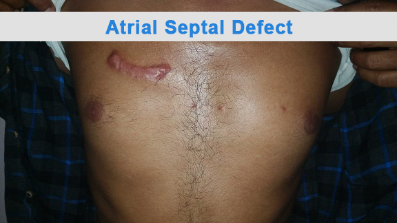 AVR - Aortic Valve Replacement surgical photo