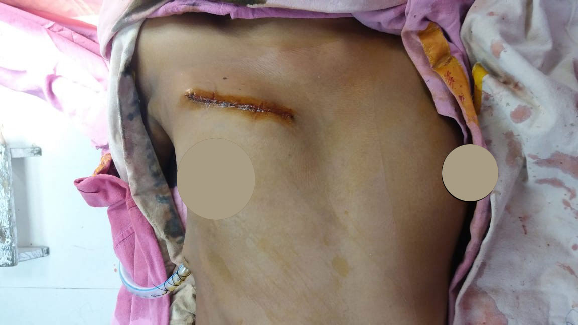 AVR - Aortic Valve Replacement surgical photo