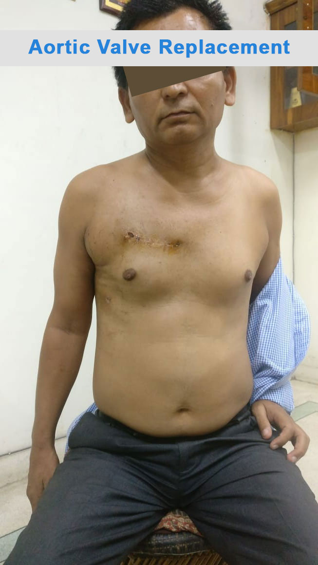 AVR - Aortic Valve Replacement surgical photo