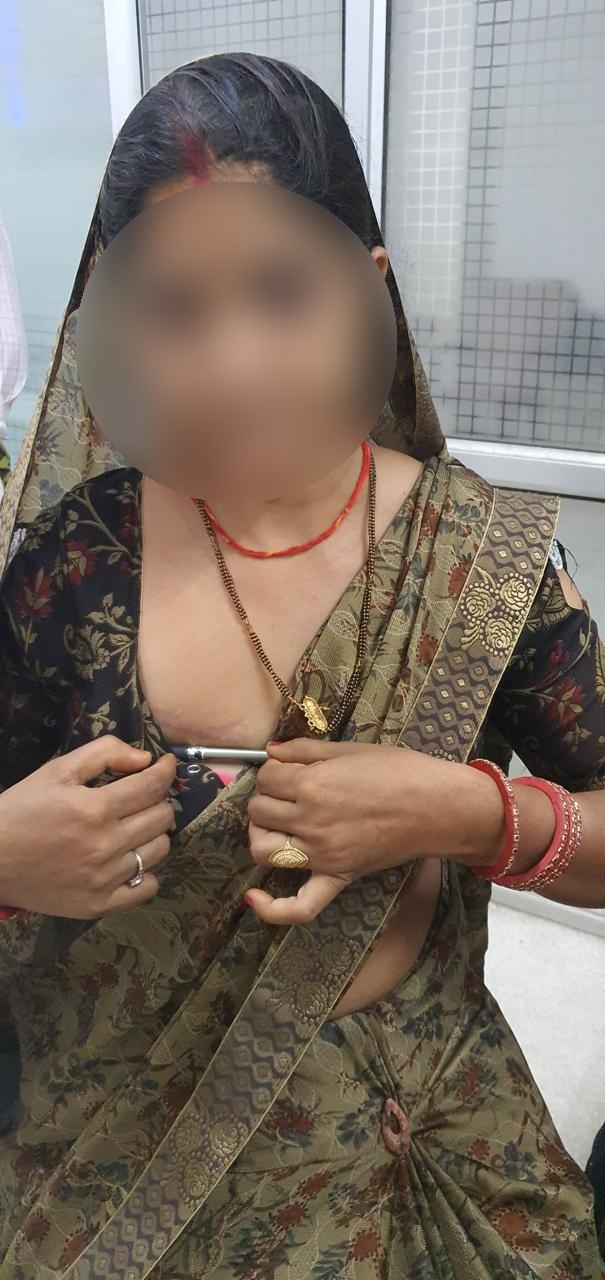 AVR - Aortic Valve Replacement surgical photo