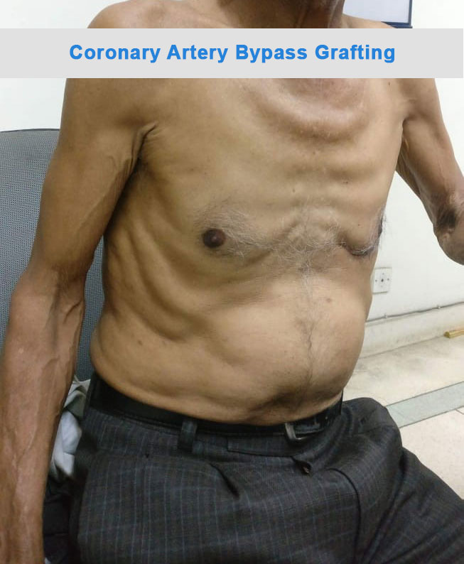 CABG - Coronary Artery Bypass surgical photo