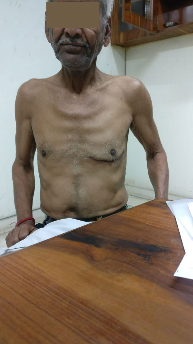 CABG - Coronary Artery Bypass surgical photo