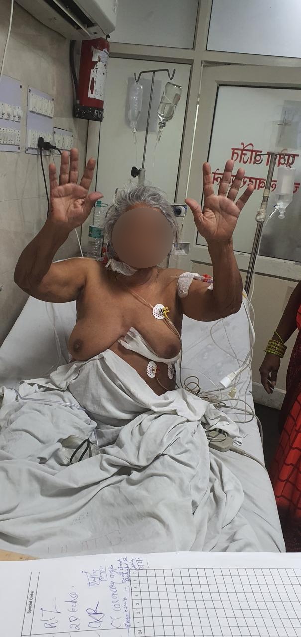 CABG - Coronary Artery Bypass surgical photo