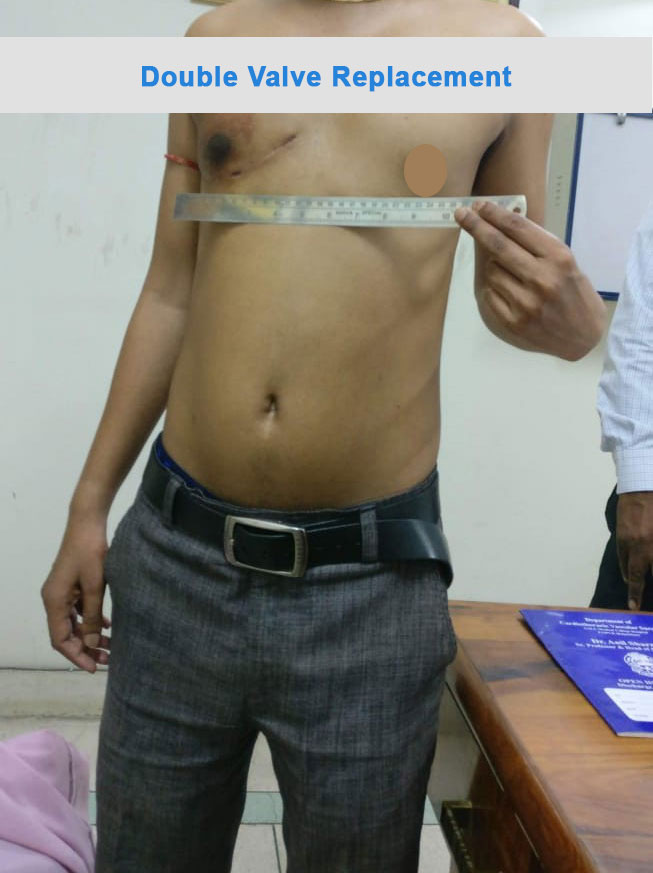 DVR - Double Valve Replacement surgical photo