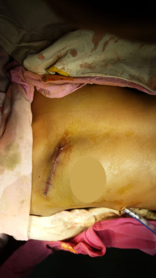 DVR - Double Valve Replacement surgical photo