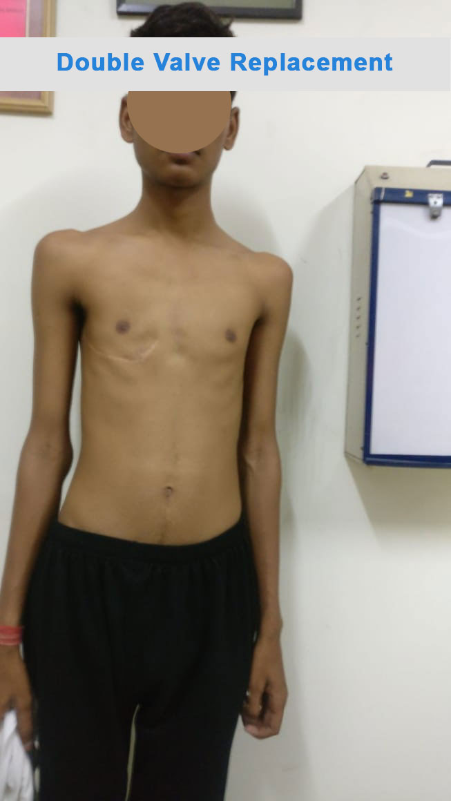 DVR - Double Valve Replacement surgical photo