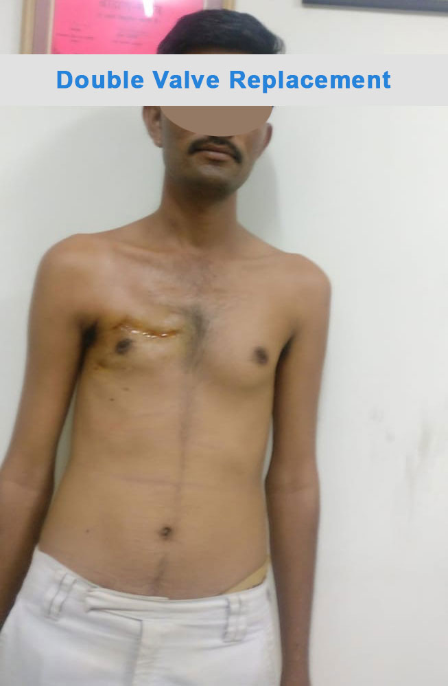 DVR - Double Valve Replacement surgical photo