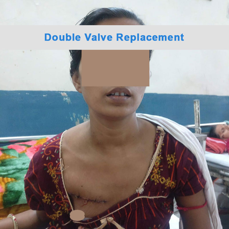 DVR - Double Valve Replacement surgical photo