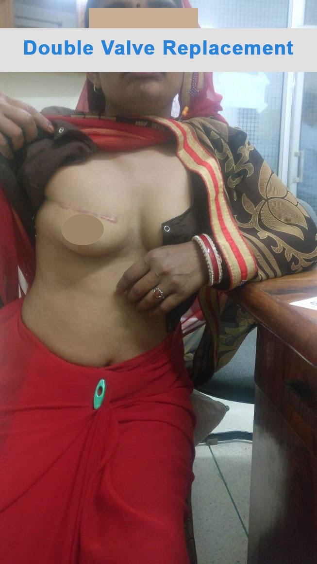 DVR - Double Valve Replacement surgical photo