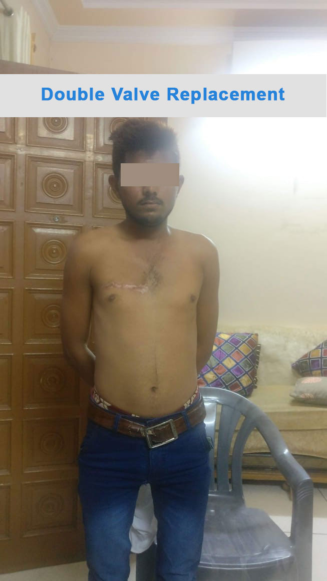 DVR - Double Valve Replacement surgical photo