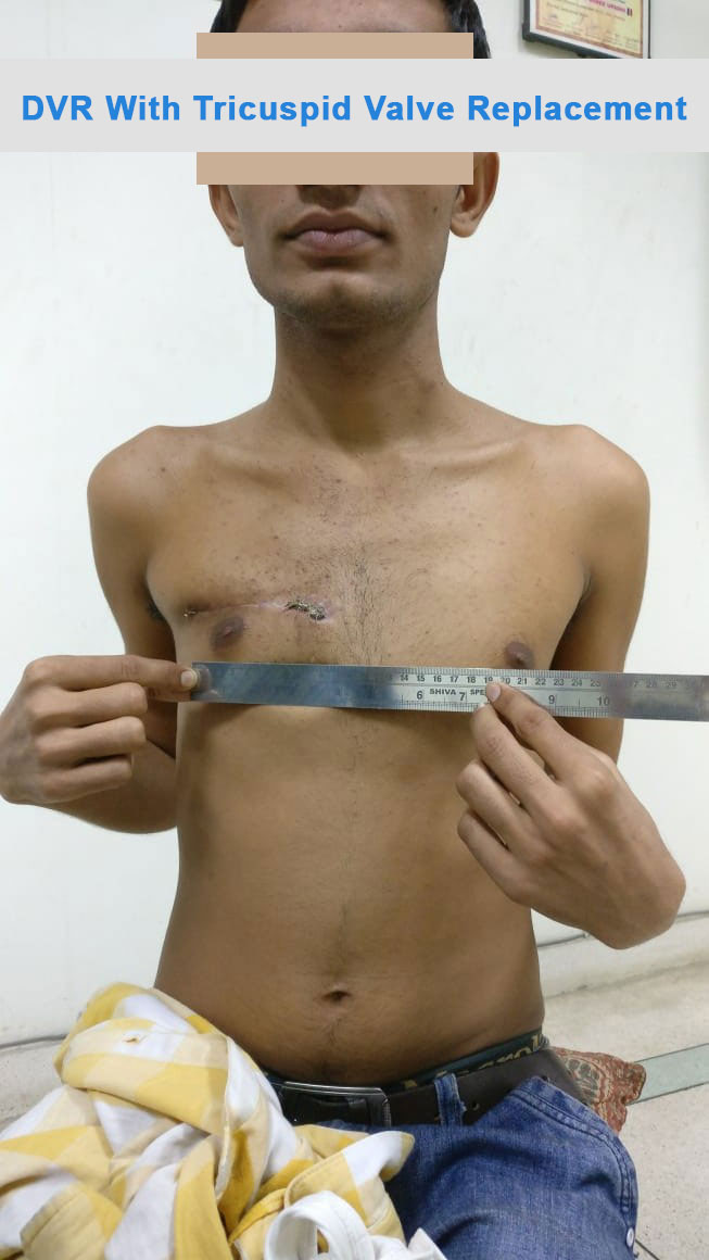 DVR - Double Valve Replacement surgical photo