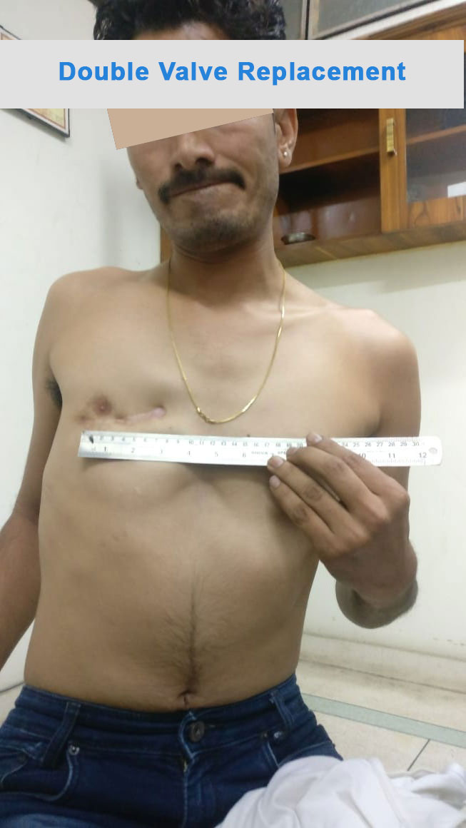 DVR - Double Valve Replacement surgical photo