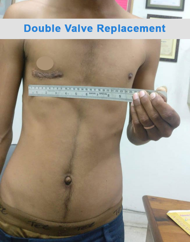 DVR - Double Valve Replacement surgical photo