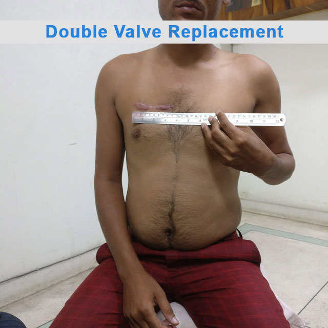 DVR - Double Valve Replacement surgical photo