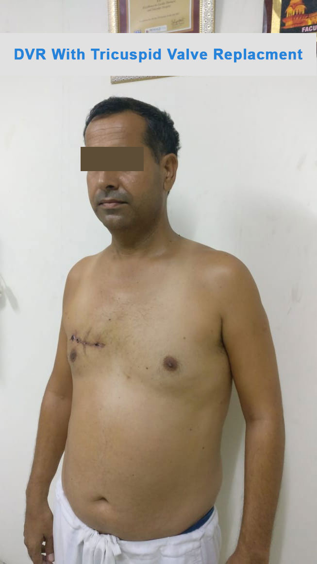 DVR - Double Valve Replacement surgical photo