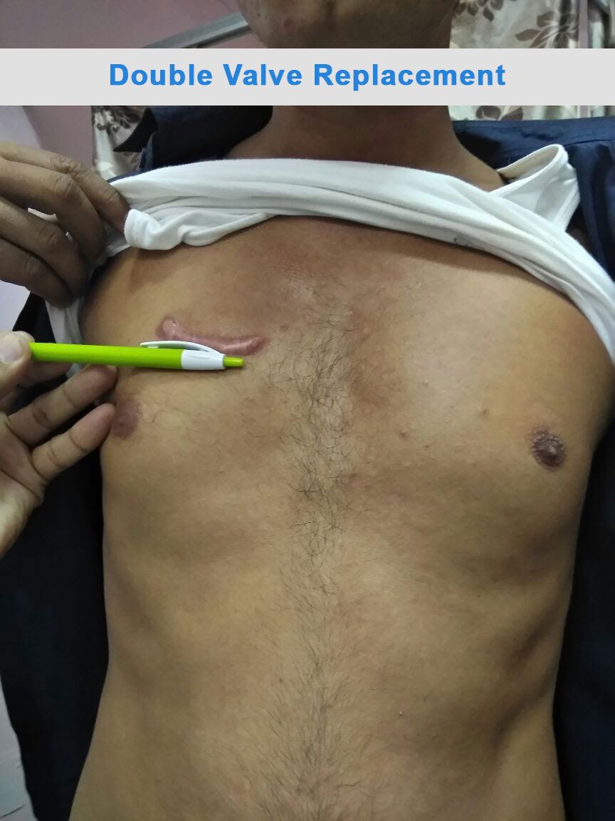 DVR - Double Valve Replacement surgical photo