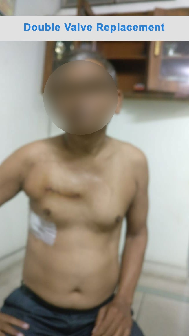 DVR - Double Valve Replacement surgical photo