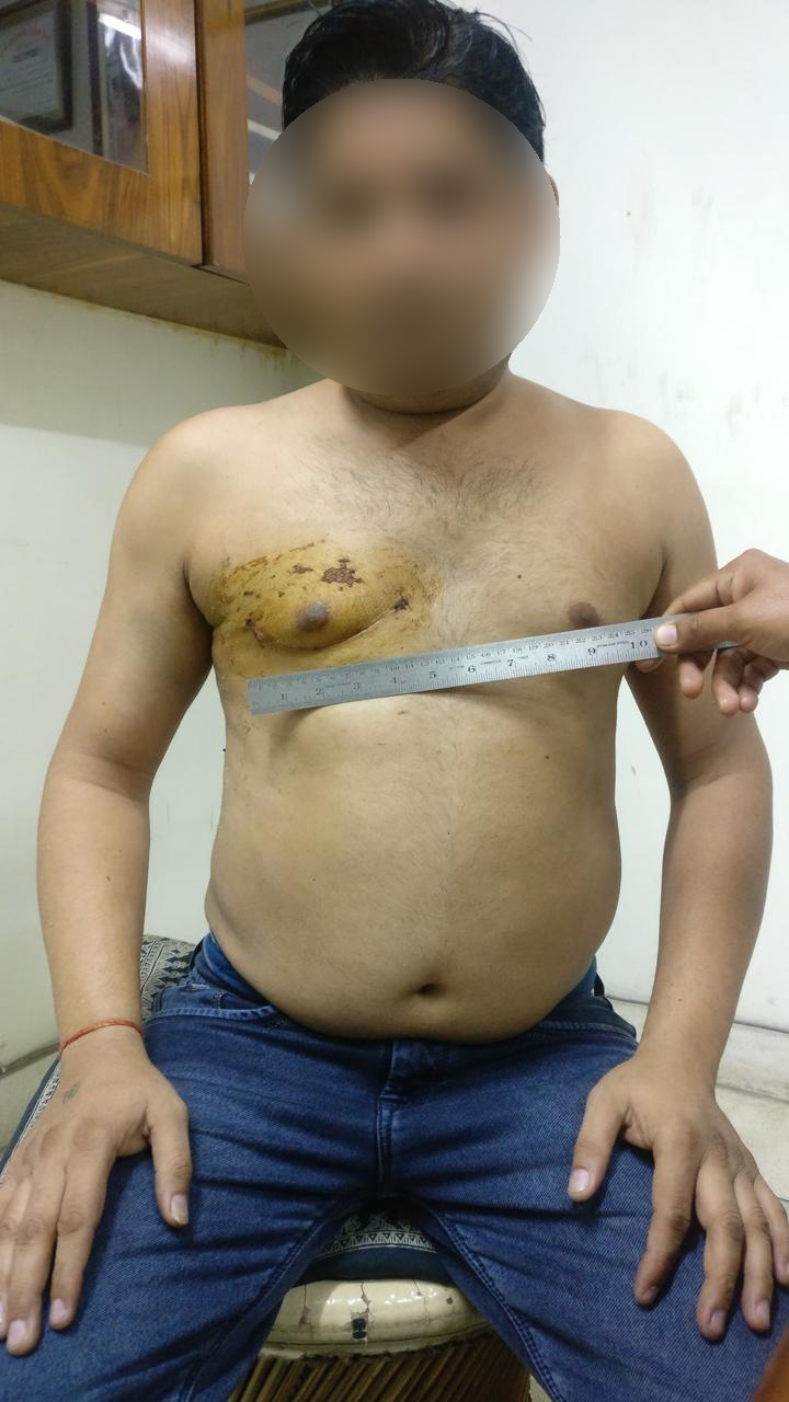 DVR - Double Valve Replacement surgical photo