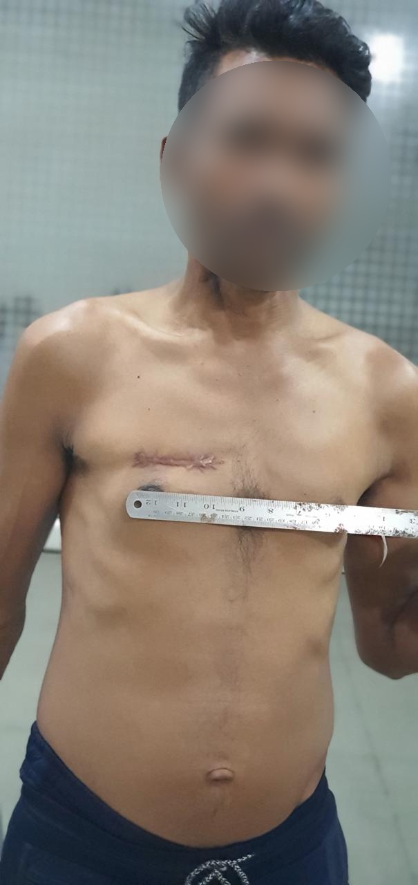 DVR - Double Valve Replacement surgical photo