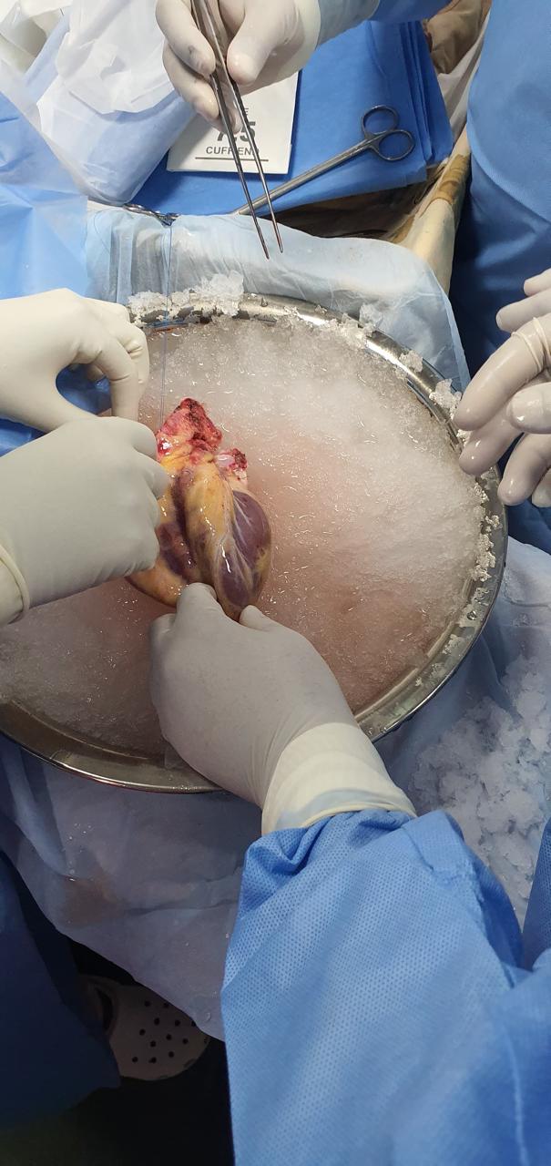 Heart Transplant surgical photo