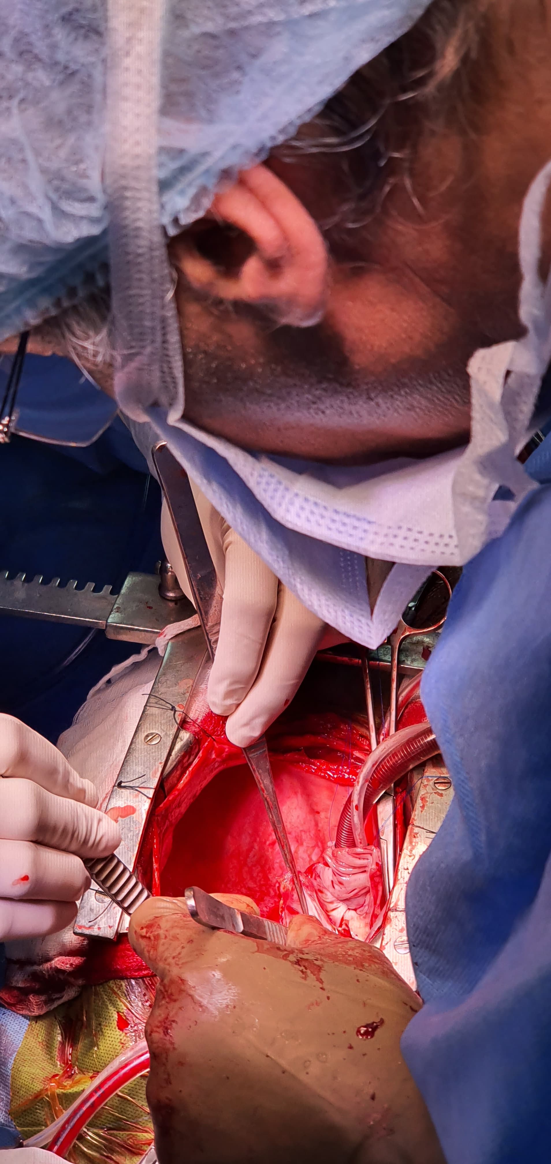 Heart Transplant surgical photo