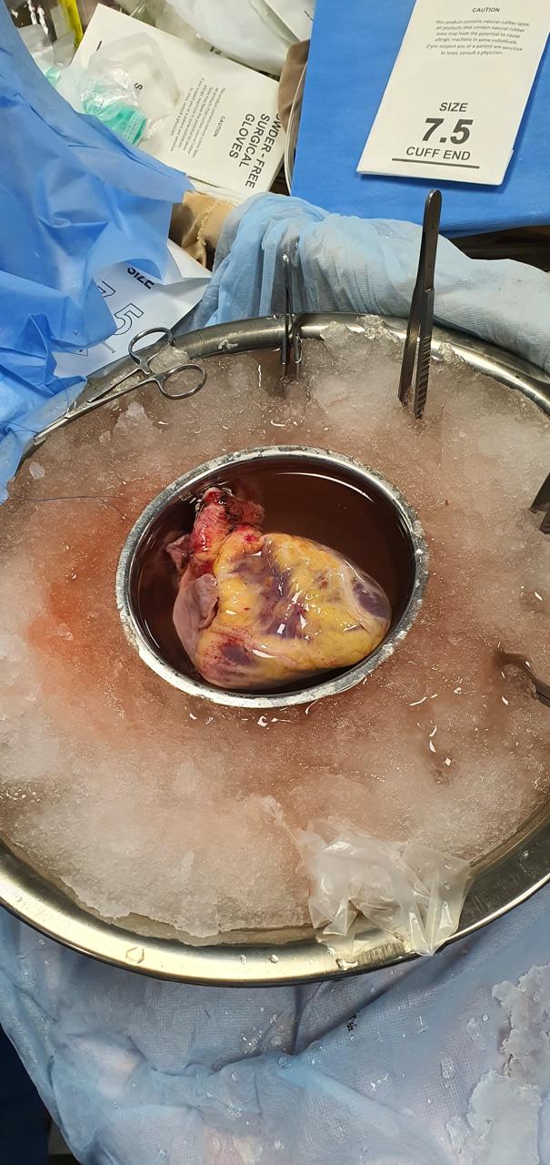 Heart Transplant surgical photo