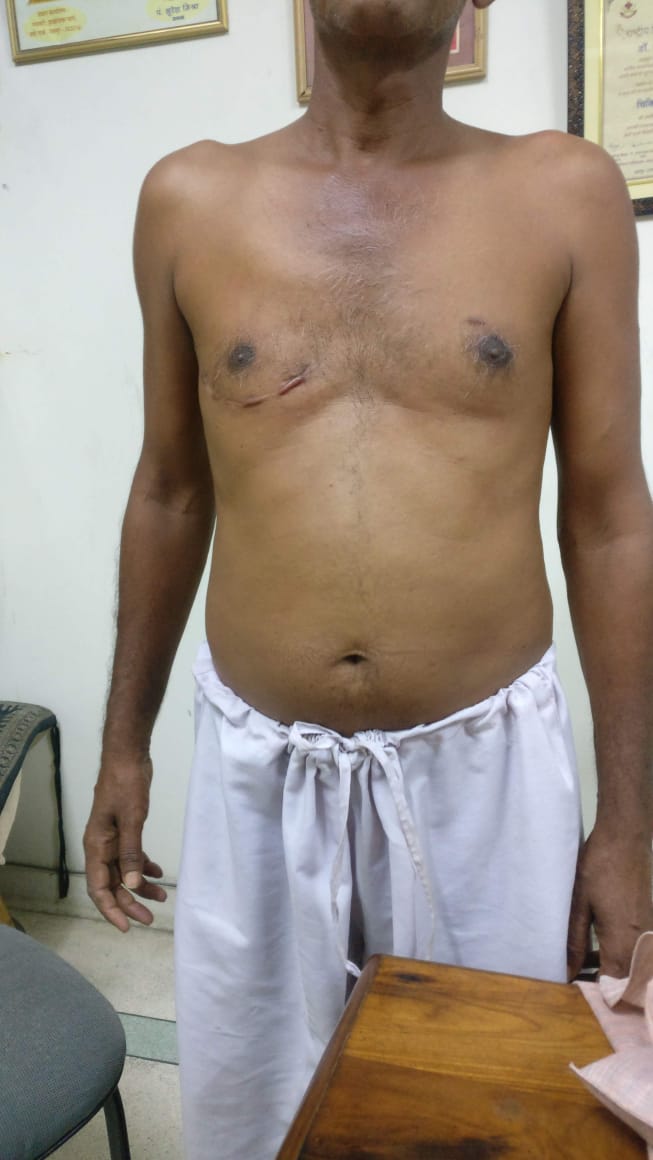 MVR - Mitral Valve Replacement surgical photo