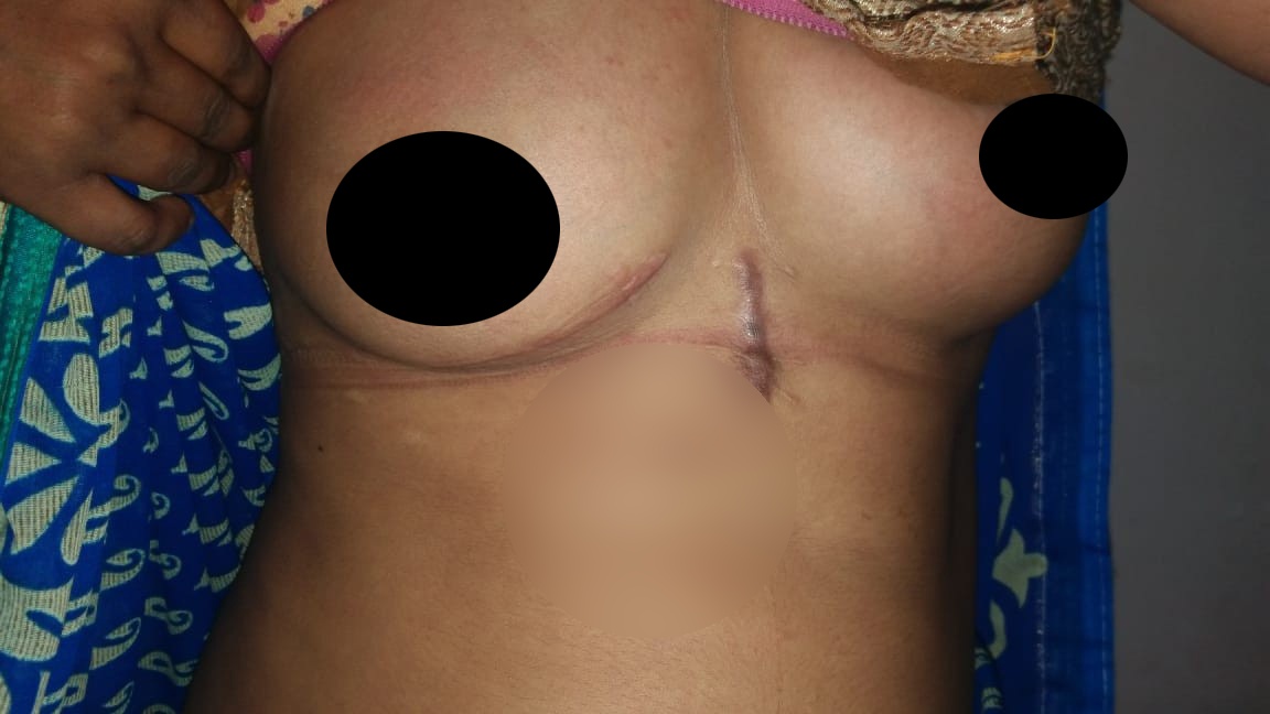 MVR - Mitral Valve Replacement surgical photo