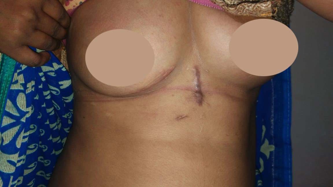 MVR - Mitral Valve Replacement surgical photo