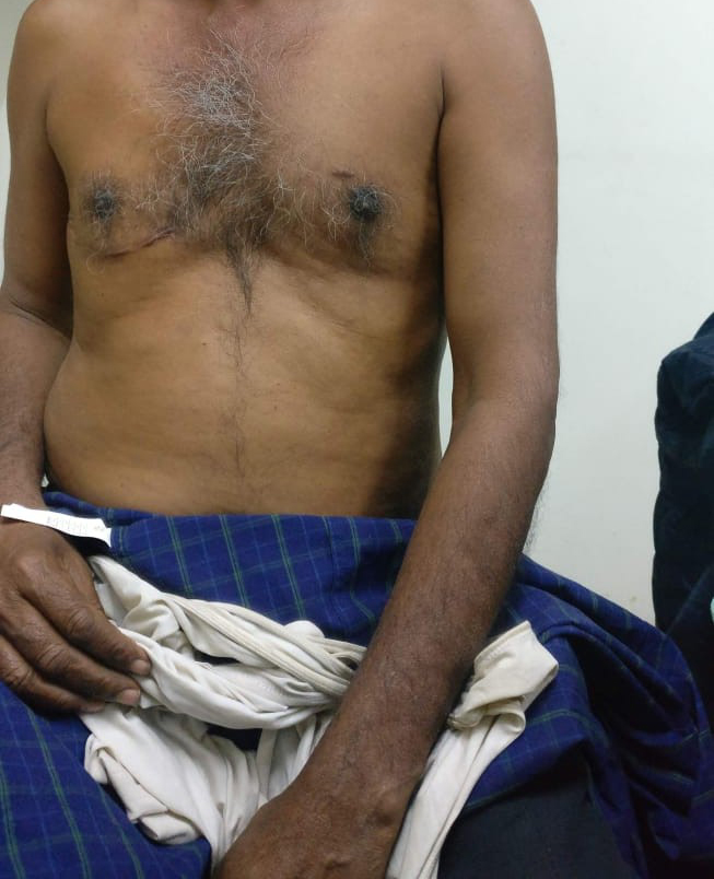 MVR - Mitral Valve Replacement surgical photo