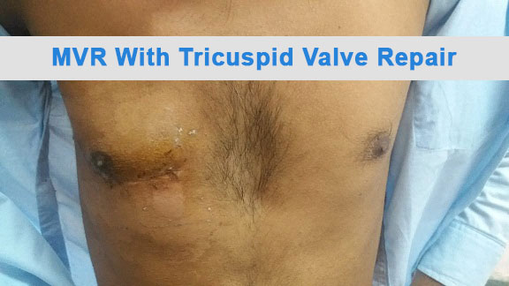 MVR - Mitral Valve Replacement surgical photo