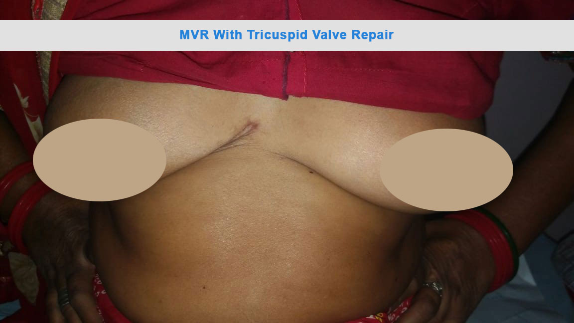 MVR - Mitral Valve Replacement surgical photo