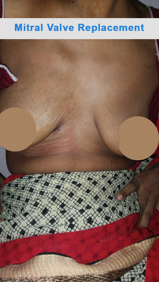 MVR - Mitral Valve Replacement surgical photo