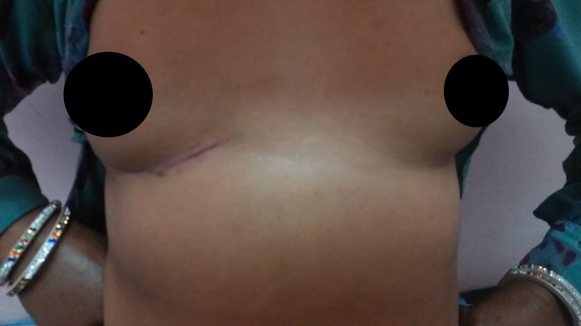 MVR - Mitral Valve Replacement surgical photo