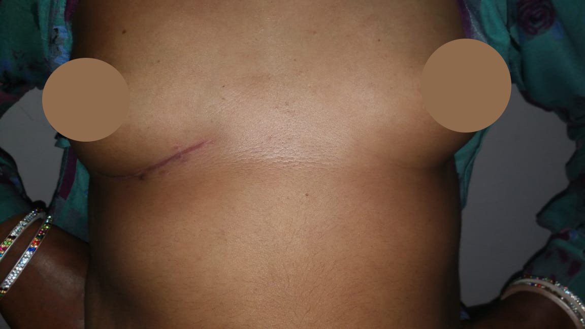 MVR - Mitral Valve Replacement surgical photo